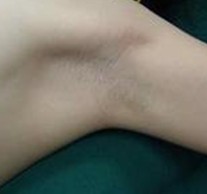 狐臭明显症状有以下几点