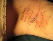 狐臭手术多少钱