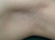 腋臭的根本原因