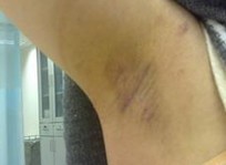 女性腋臭危害多