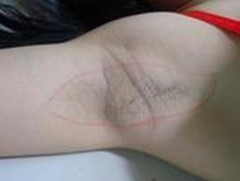 狐臭不及时治疗的危害